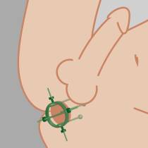 SPECULUM DILATATION FIST